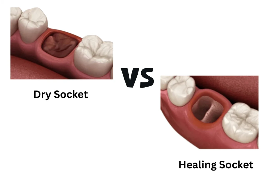 healthy healing vs. dry socket